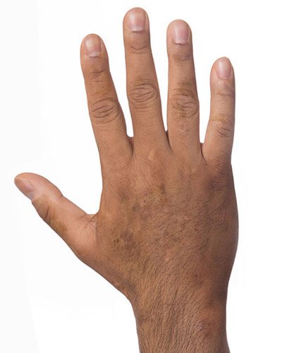 Vitiligo Treatment