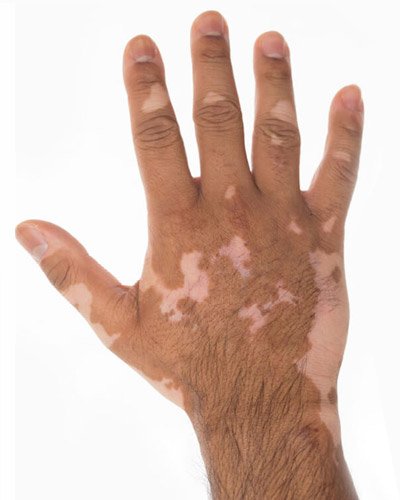 Vitiligo Treatment